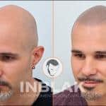 Inblak Micropigmentación Capilar – Micropigmentación Capilar