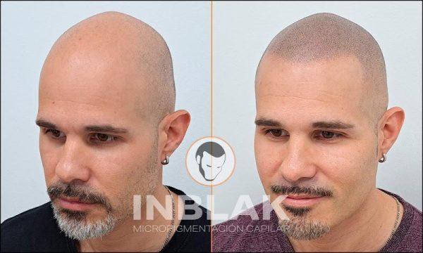 Negocio Inblak Micropigmentación Capilar