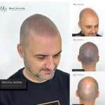 Manoli Hernández - Micropigmentación Capilar – Micropigmentación Capilar