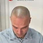 Micropigmentación Capilar Barcelona – Micropigmentación Capilar