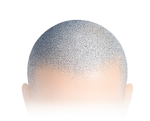 Micropigmentación Capilar Profesional | Guía y Clínicas Especializadas