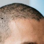 Micropigmentación capilar en pacientes con psoriasis y dermatitis